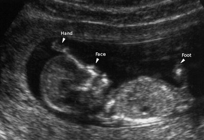 3rd Baby scan, 12 weeks